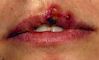 Oral herpes - cold sore, fever blister