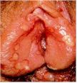 Genital Herpes - vaginal