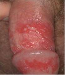Genital Herpes - penile